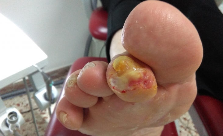immagine 3 di Piede diabetico