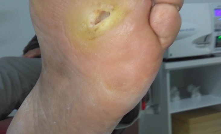immagine 1 di Piede diabetico