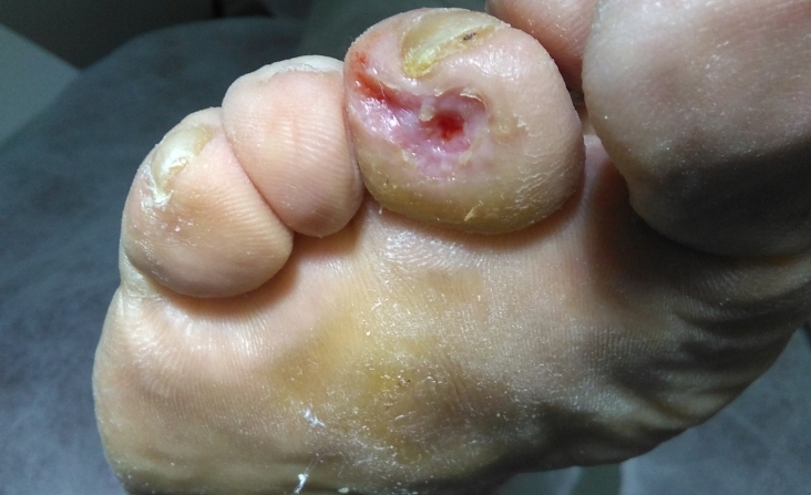 immagine 2 di Piede diabetico